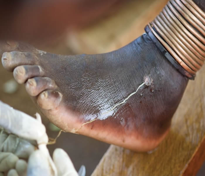 Guinea Worm Causes, Symptoms, Treatment, Diagnosis and Prevention