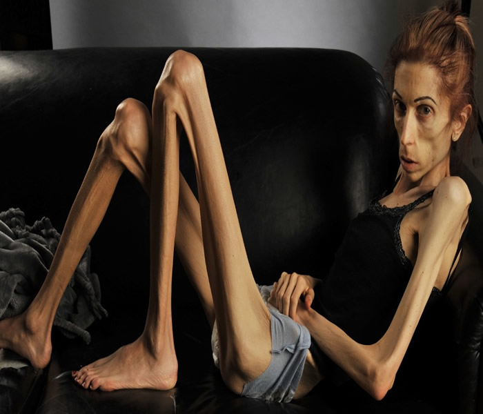 Anorexia Nervosa