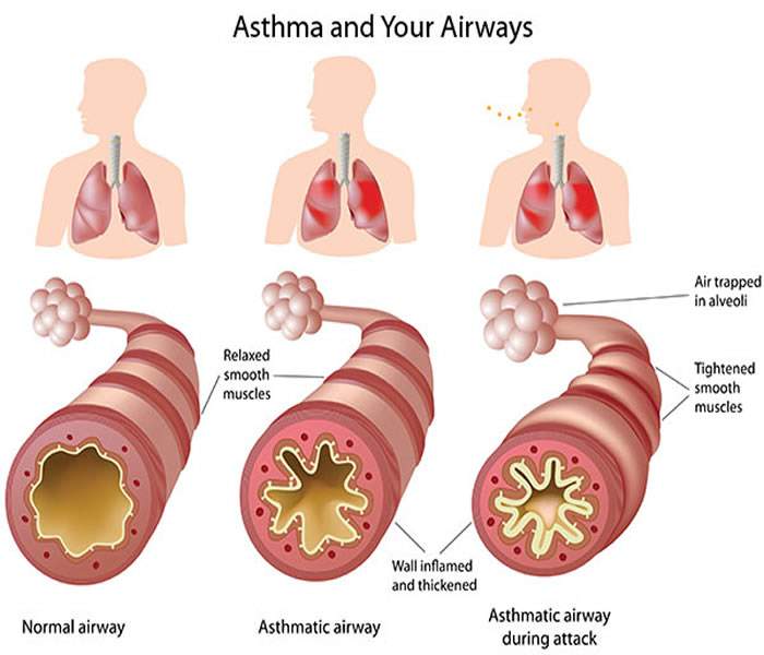 Asthma cough