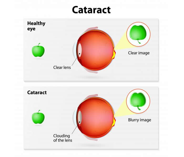 CATARACTS: MEANING, TYPES, SYMPTOMS, PREVENTION, TREATMENTS AND HOME REMEDIES
