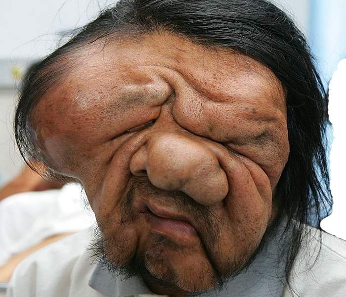 Image result for elephantiasis