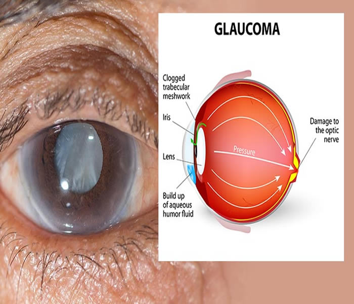 Glaucooma