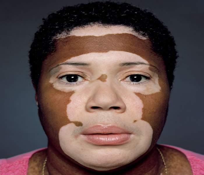 Skin depigmentation