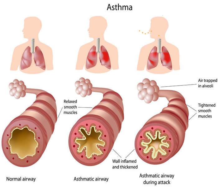 Asthma-Cough