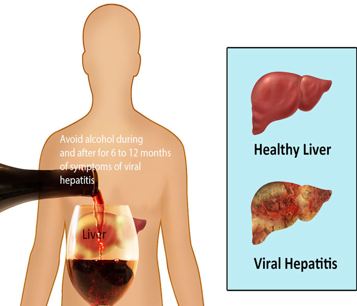 Hepatitis