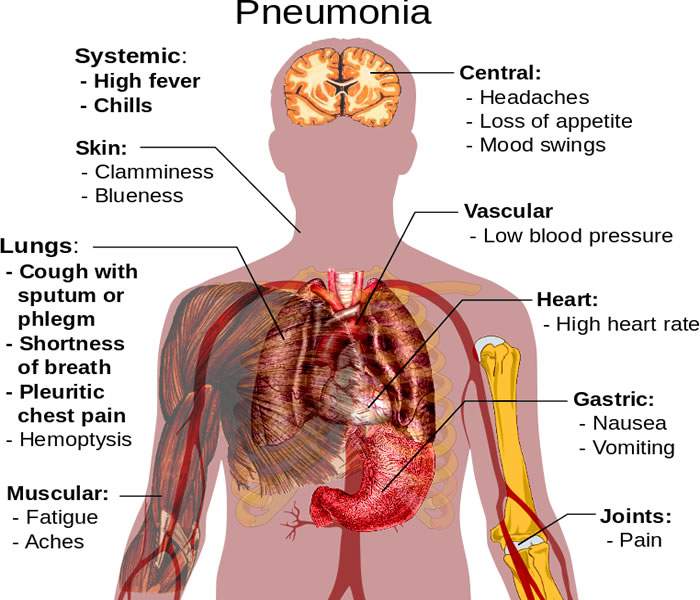 Pneumonia Causes Symptoms Treatment Diagnosis And Prevention