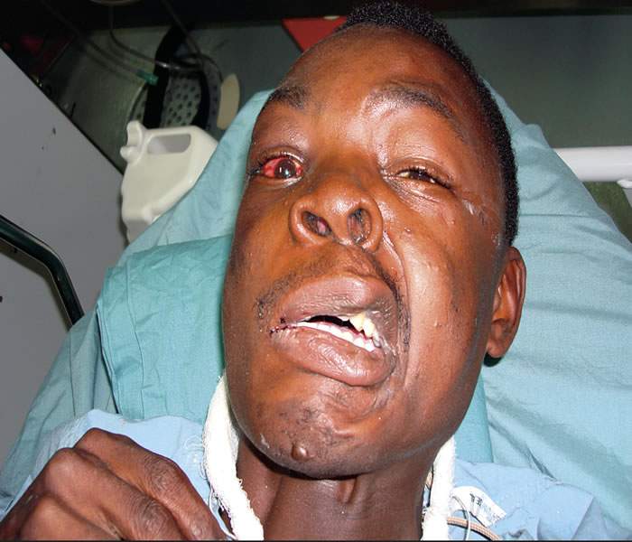 Tetanus Disease Symptoms