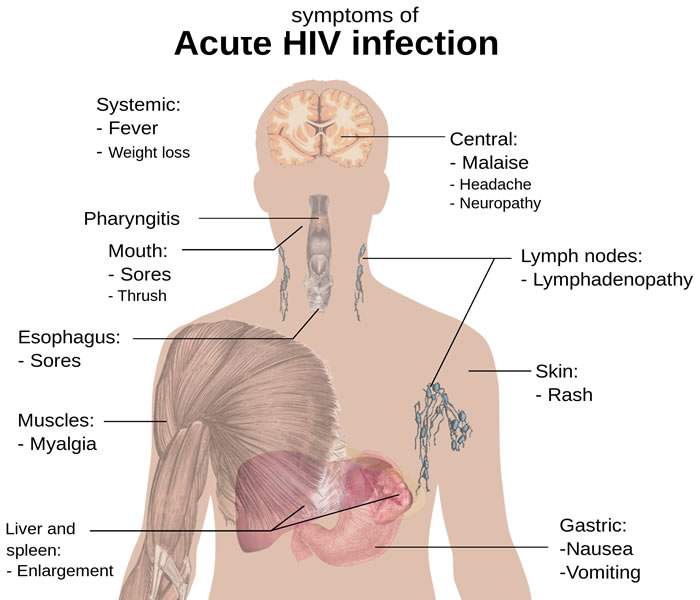 HIV/AIDS cough
