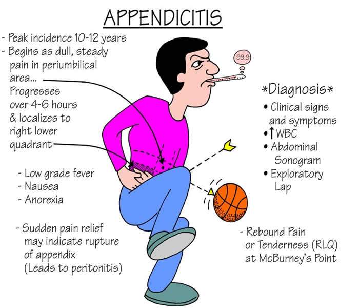 Appendicitis Signs And Symptoms