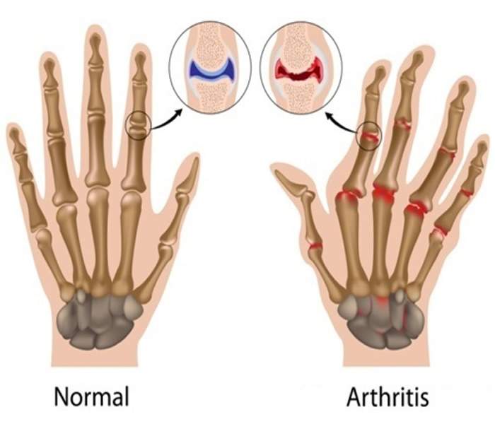 Arthritis