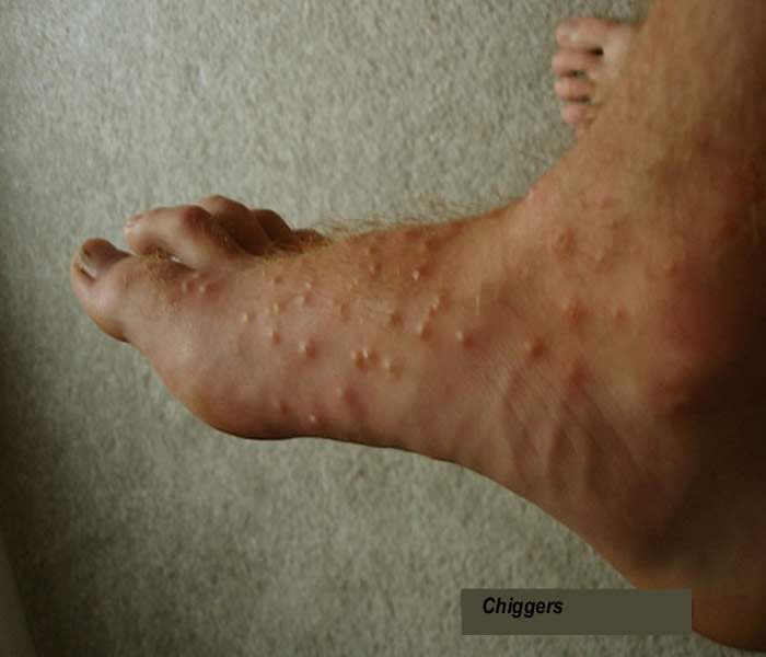 Chiggers