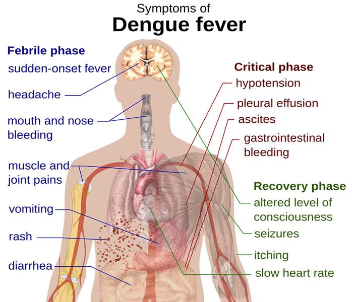 Dengue