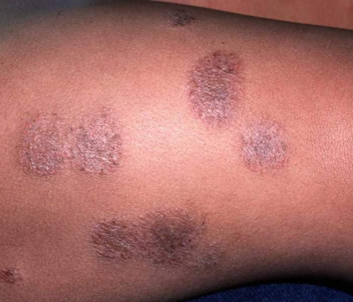 eczema treatment cream in nigeria vörös foltok a bőrön például anyajegyek