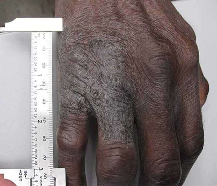 Eczema