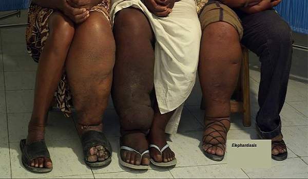 Elephantiasis