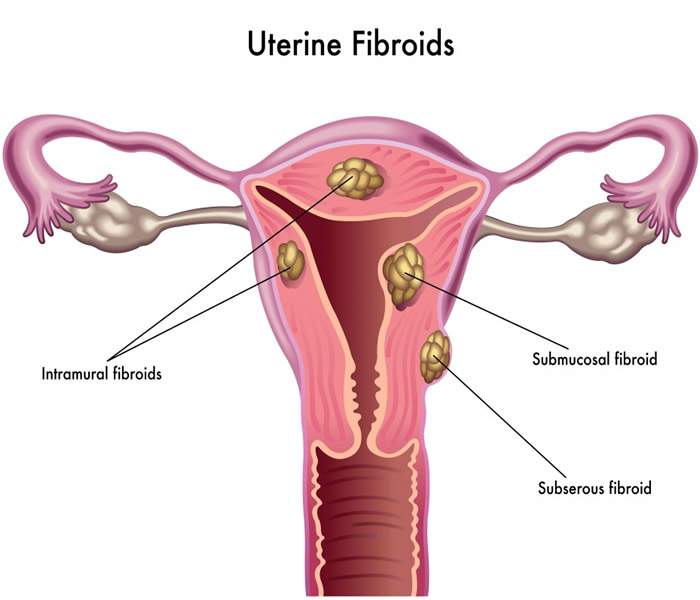 Fibroids