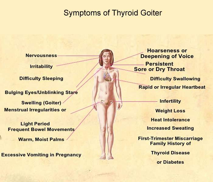 Goiter