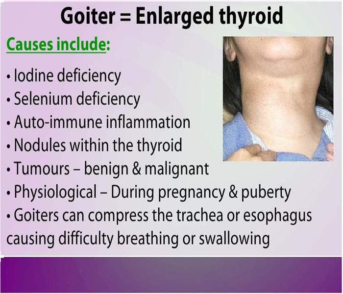 Goiter Symptoms Treatment