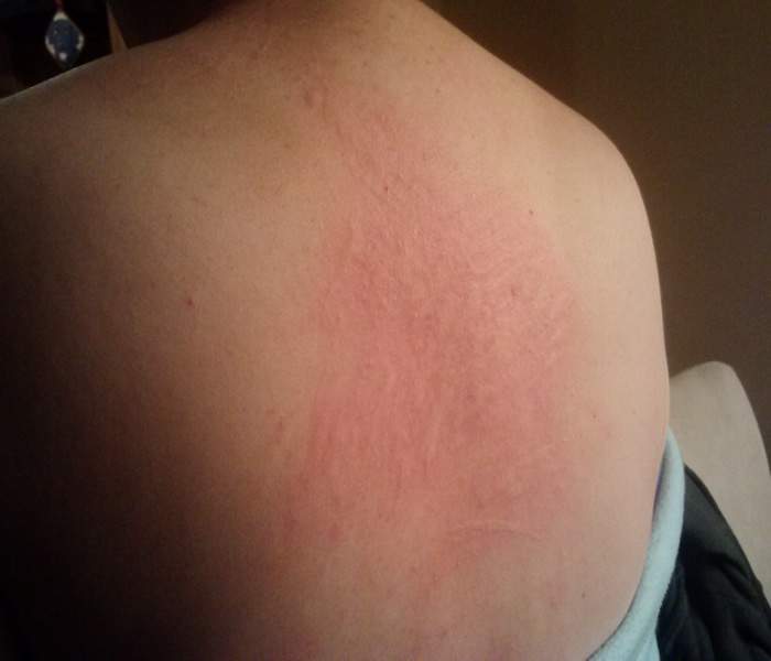 Welts or Hives