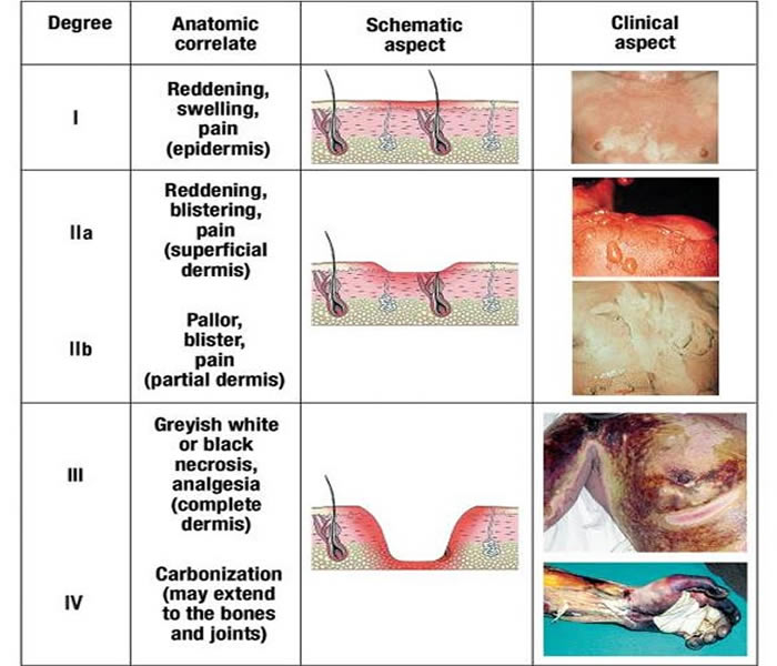 Burns Causes, Symptoms, Treatment, Diagnosis and Prevention