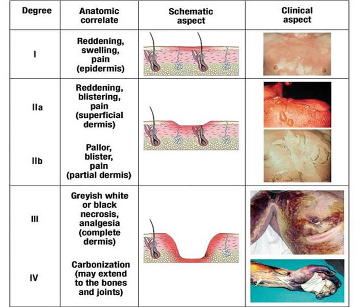 3rd degree burn healing time