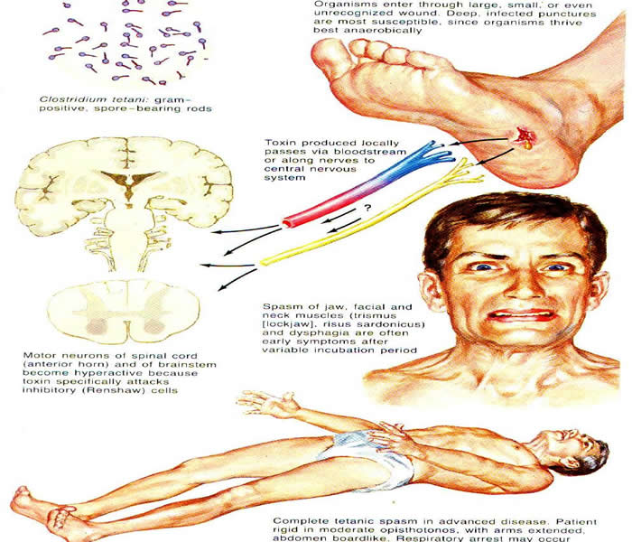 Tetanus Lock Jaw Mode Of Transmission Clinical Features Management And Prevention