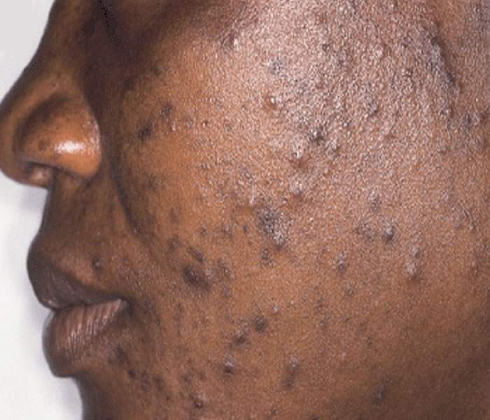 pimples on skin
