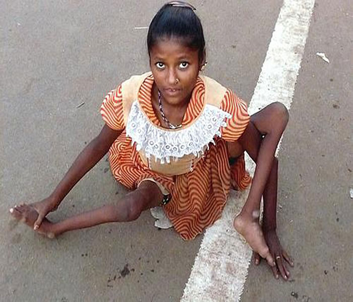 Poliomyelitis Causes, Symptoms, Treatment, Diagnosis and Prevention