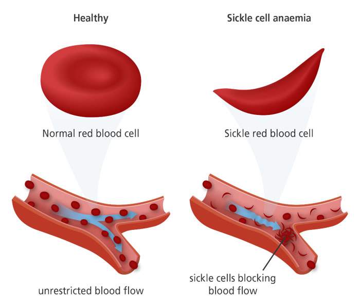 sickle-cell