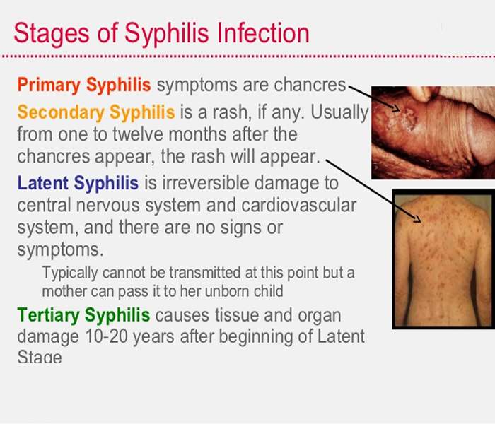 Syphilis