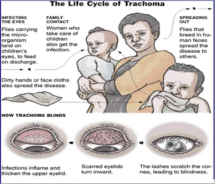 Trachoma