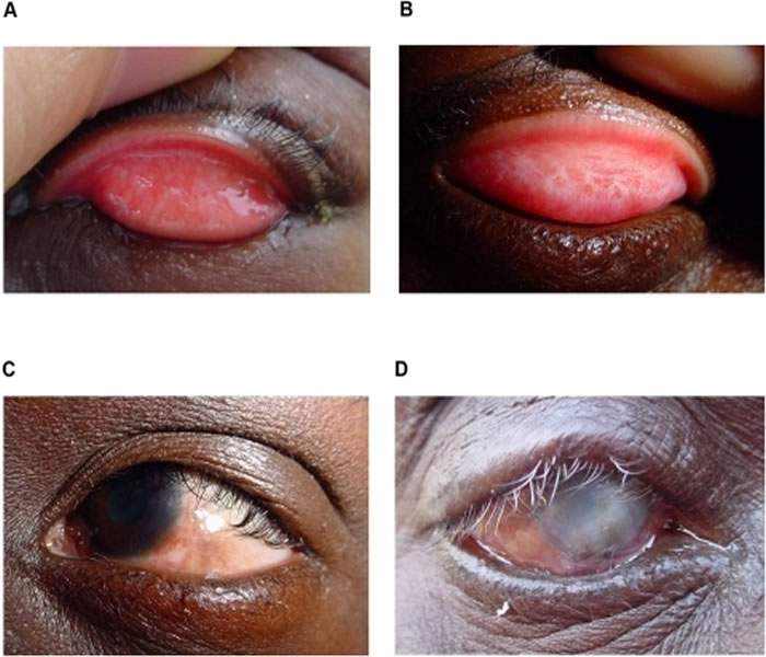 Trachoma