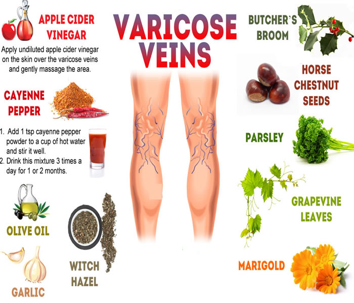 varicose-veins