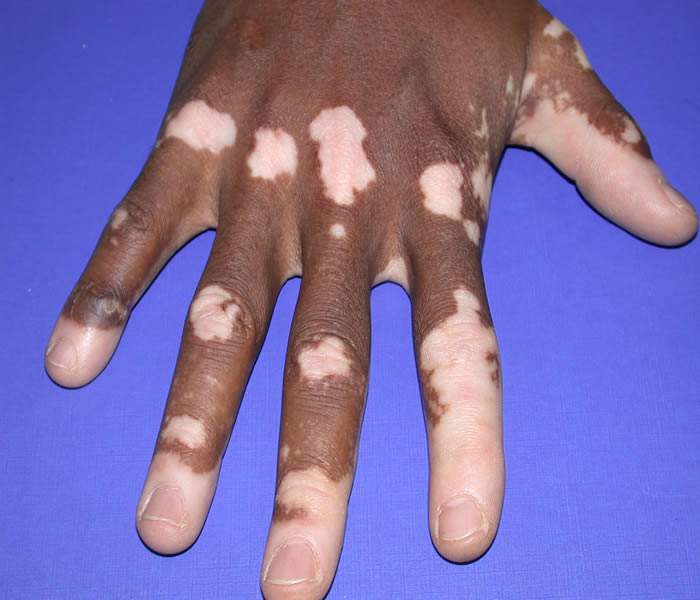 Skin depigmentation