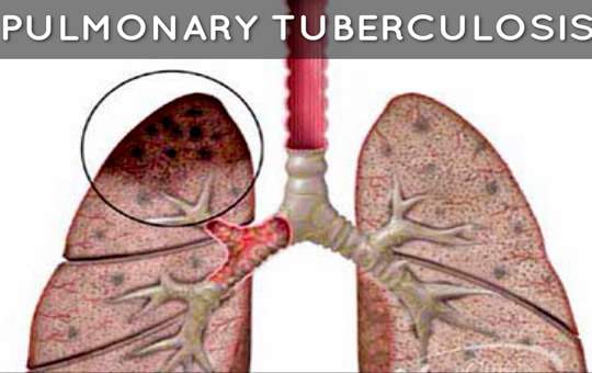 ng-pulmonary