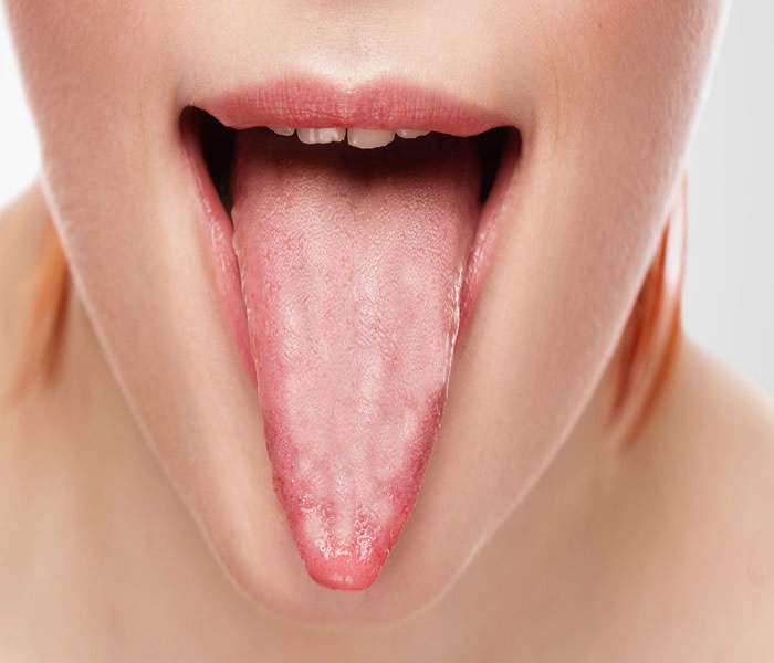 Coated/ White tongue