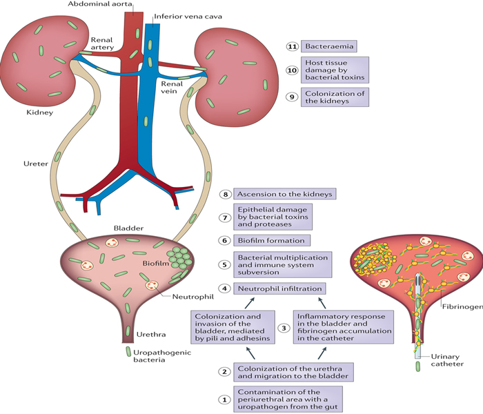 urinary tract infection